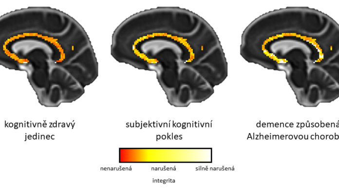 A new method can detect Alzheimer's disease before you actualy start having problems